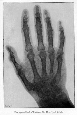 X-ray of Lord Kelvin's hand