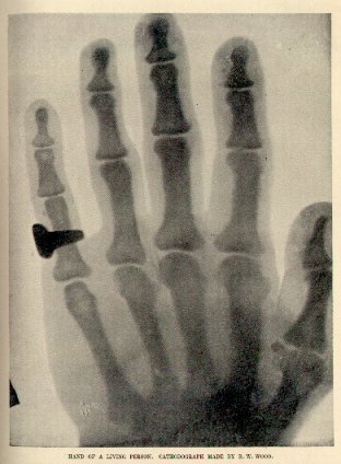 This X-ray photo appears in an article published in May of the year after Roentgen's discovery. The article is made up of letters from distinquished scientists of the day, including one where Edison analyses the construction of X-ray systems.