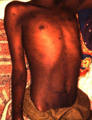 Rash in a man with epidemic typhus in Burundi