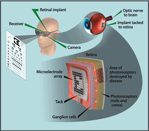 retinal prosthesis graphic